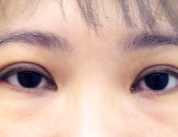 眼袋淚溝