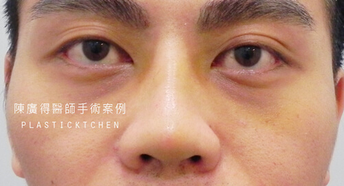 兩段式隆鼻