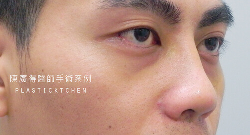 兩段式隆鼻