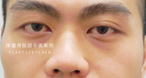 兩段式隆鼻