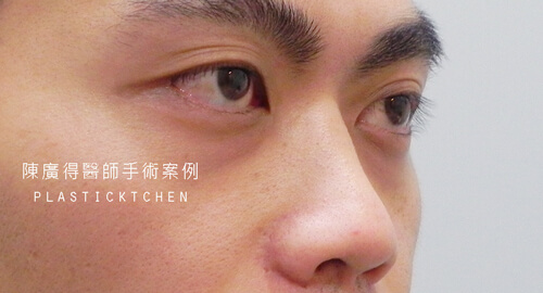 兩段式隆鼻