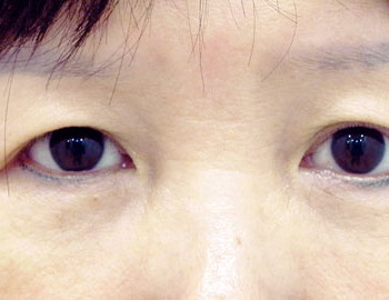 眼袋淚溝