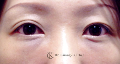 眼袋淚溝