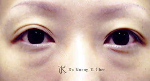 眼袋淚溝