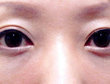 眼袋淚溝