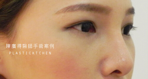 兩段式隆鼻