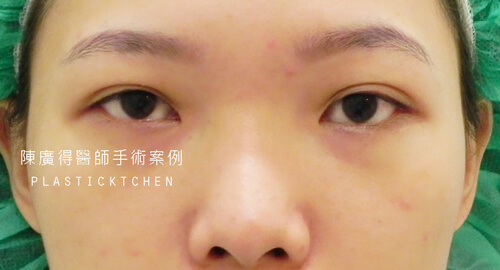 兩段式隆鼻