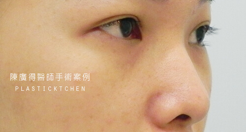 兩段式隆鼻