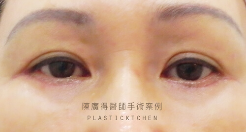 割雙眼皮