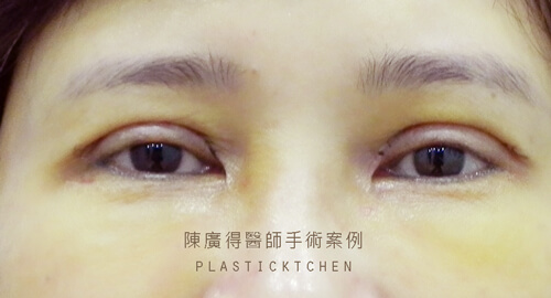 割雙眼皮