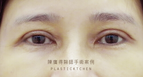 割雙眼皮