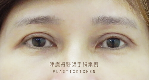 割雙眼皮