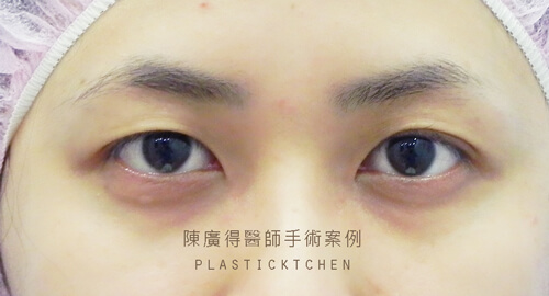 割雙眼皮