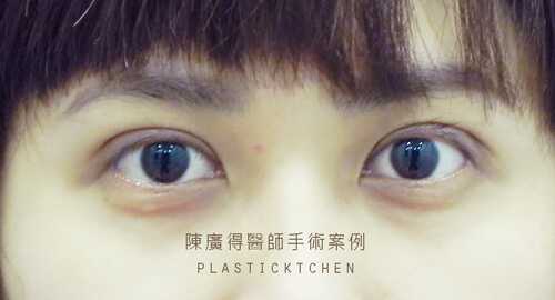 割雙眼皮