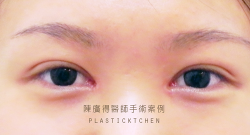 縫雙眼皮