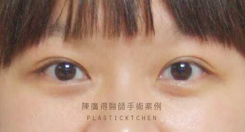 割雙眼皮