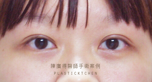 割雙眼皮