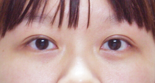 割雙眼皮