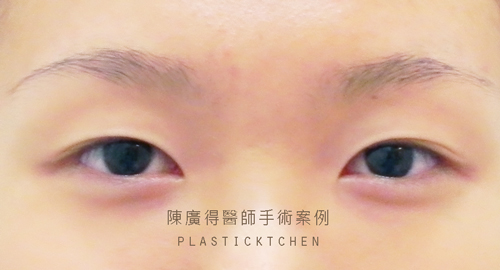 縫雙眼皮