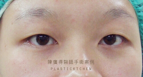 割雙眼皮