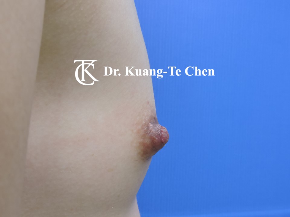 乳頭縮小術後