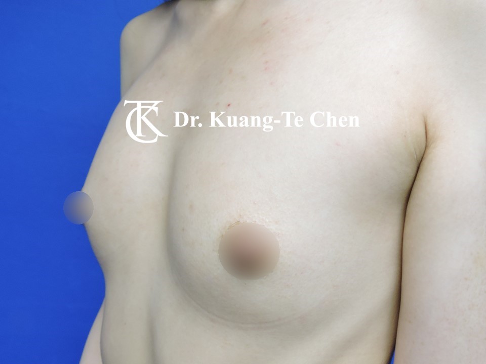 內視鏡隆乳術前