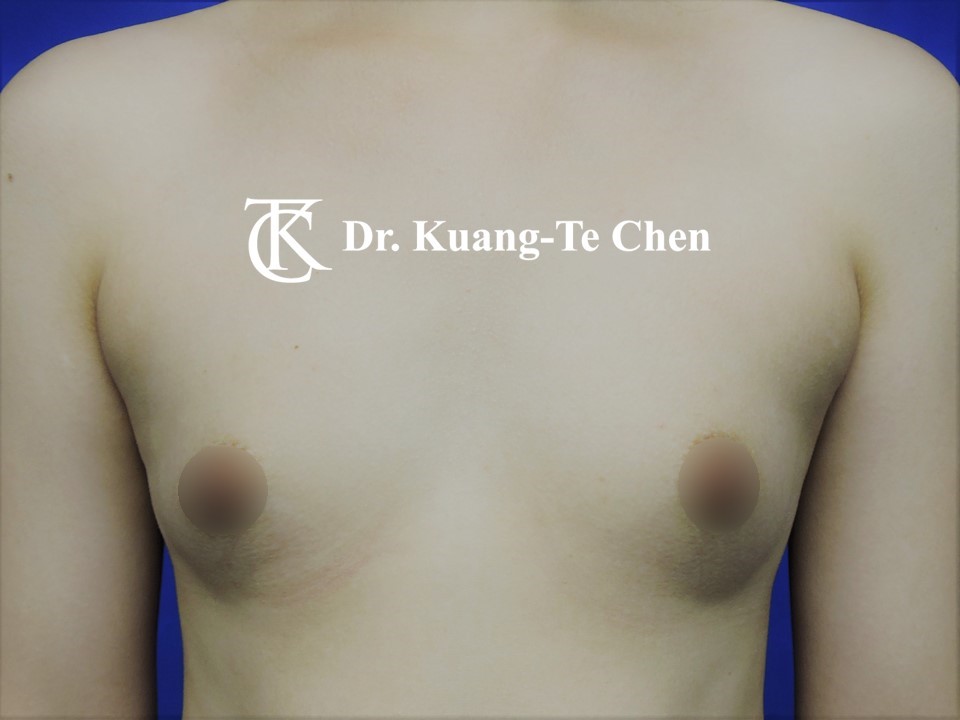 內視鏡隆乳術前