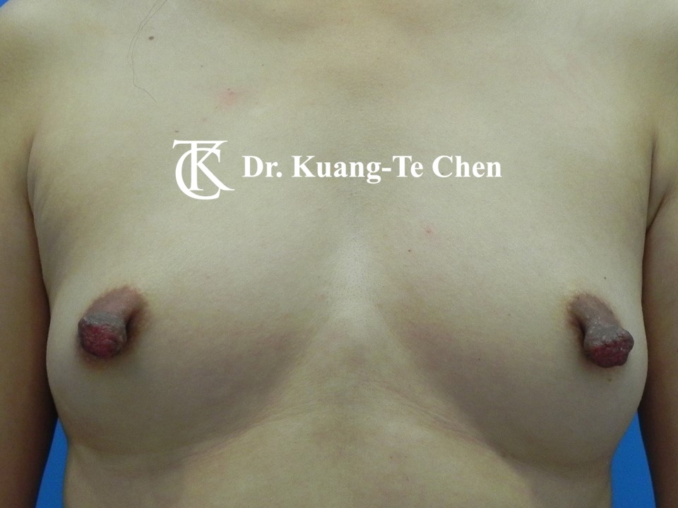 乳頭縮小術前