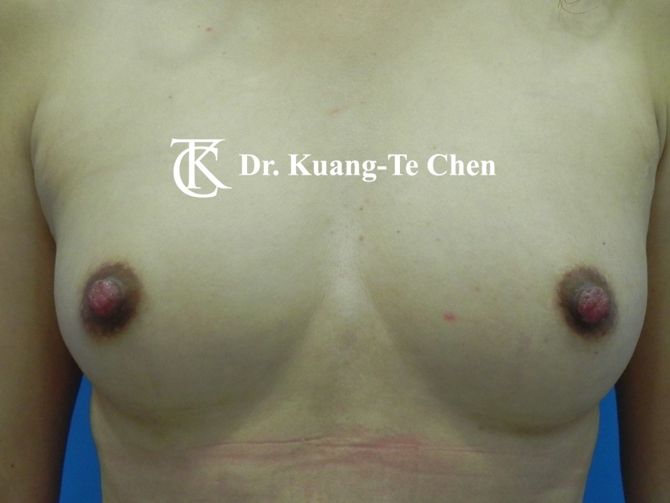 乳頭縮小術後