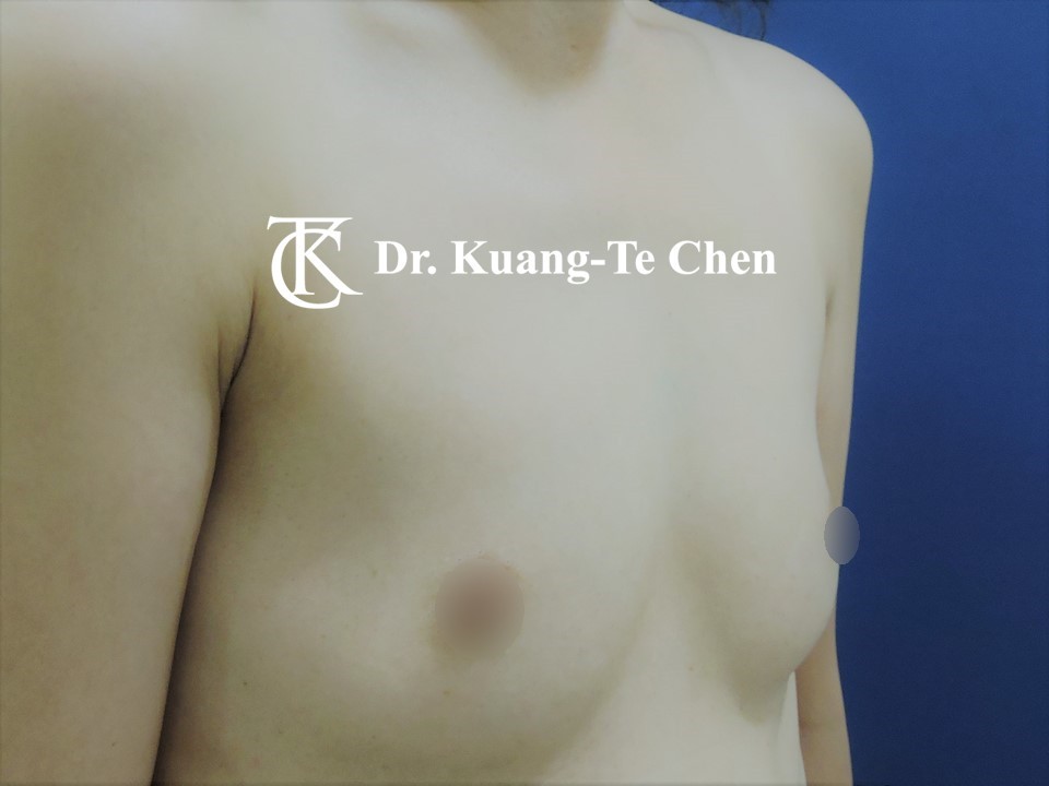 內視鏡隆乳術前