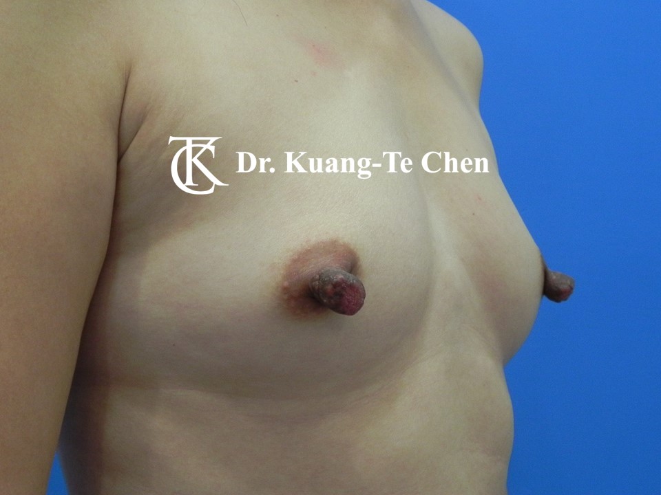 乳頭縮小術前