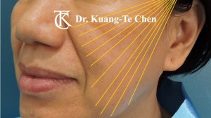 臉部埋線示意圖