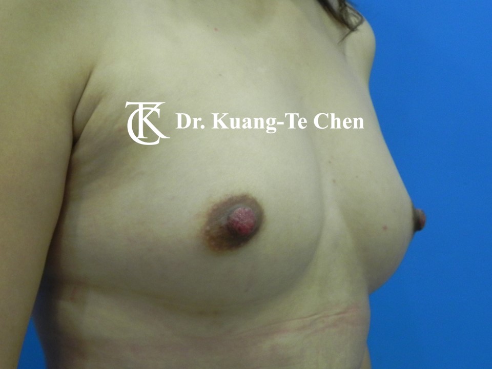 乳頭縮小術後