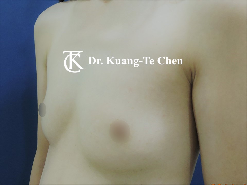 內視鏡隆乳術前