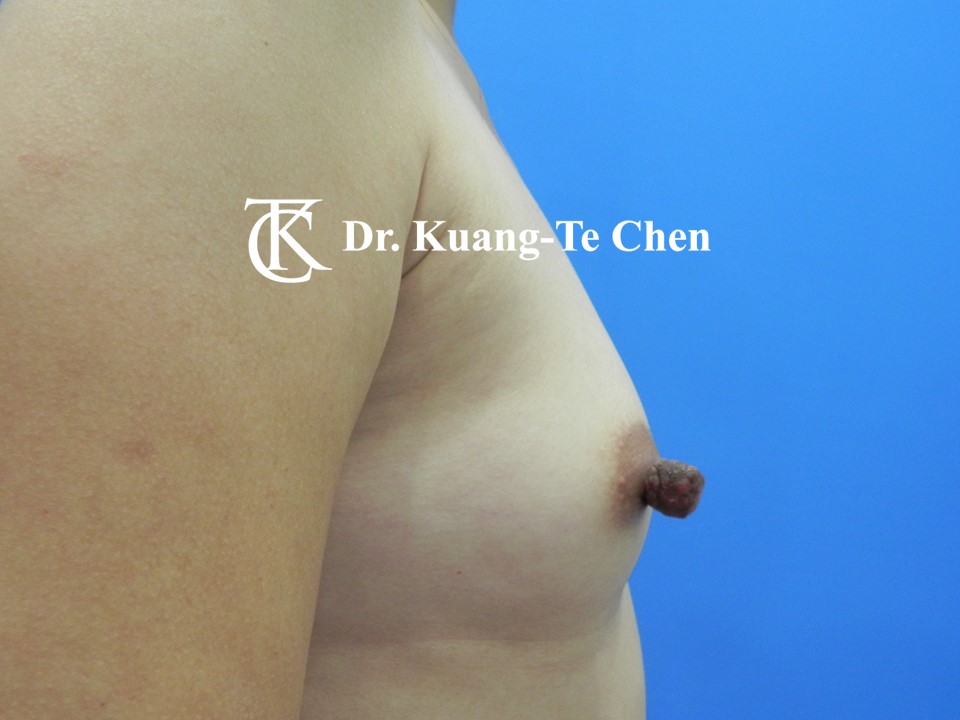 乳頭縮小術前