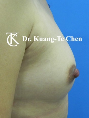乳頭縮小術後