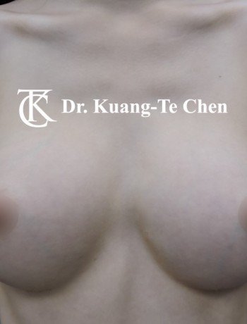 內視鏡隆乳術後