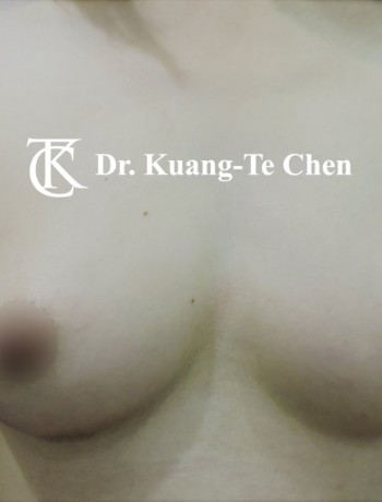 二次自體脂肪移植豐胸二次補脂術後