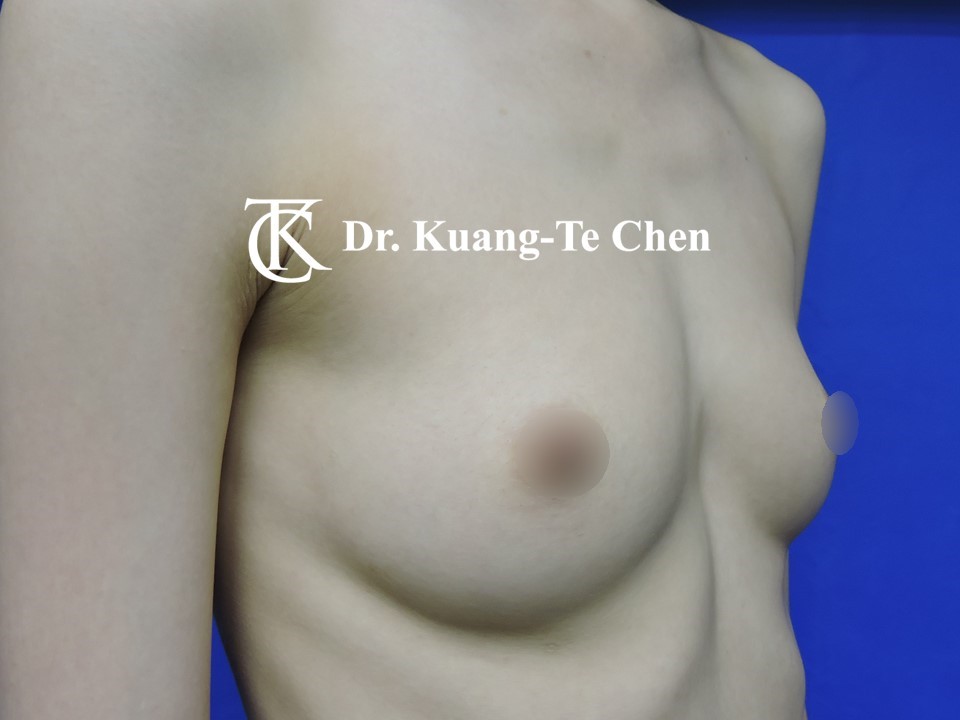 內視鏡隆乳術前