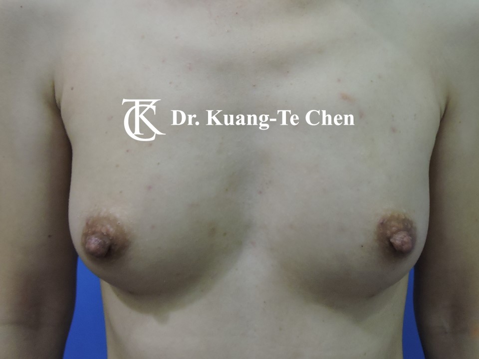 乳頭縮小術後