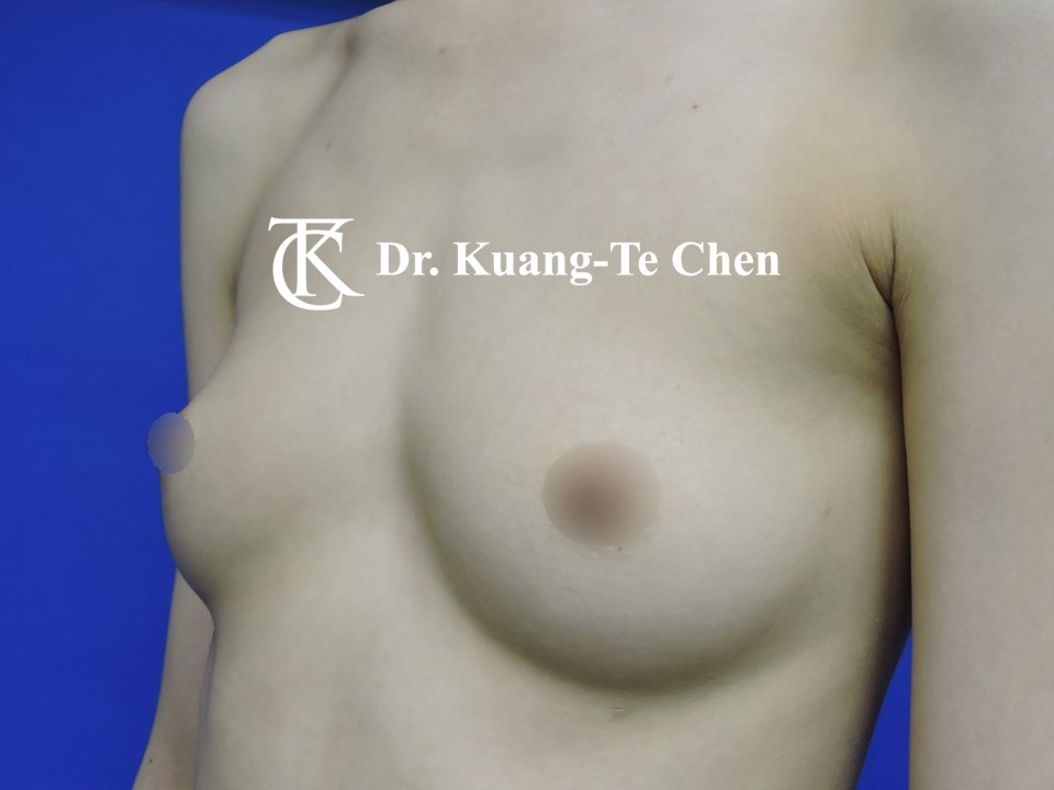 內視鏡隆乳術前