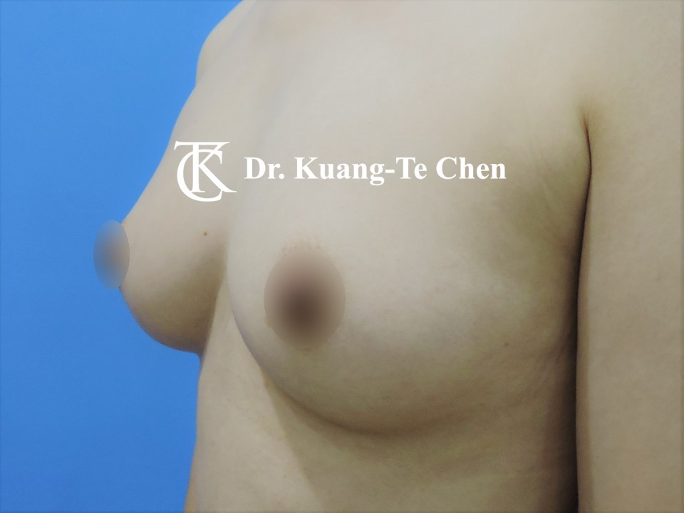 二次自體脂肪移植豐胸二次補脂術後