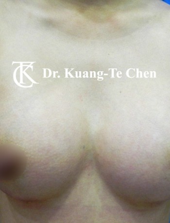 內視鏡隆乳術後