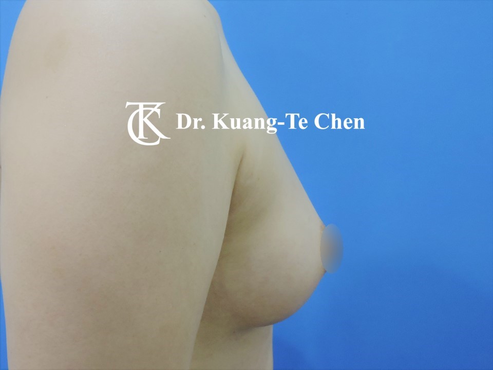 二次自體脂肪移植豐胸二次補脂術後