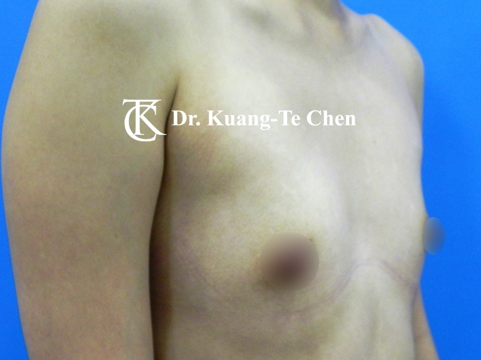 內視鏡隆乳術前