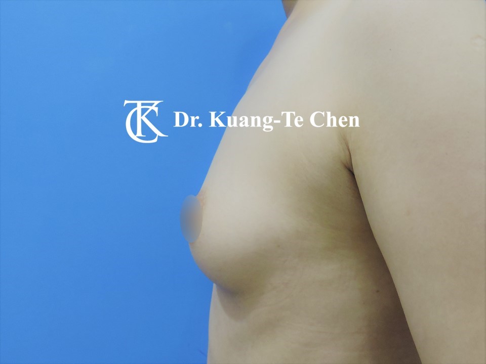 二次自體脂肪移植豐胸術前