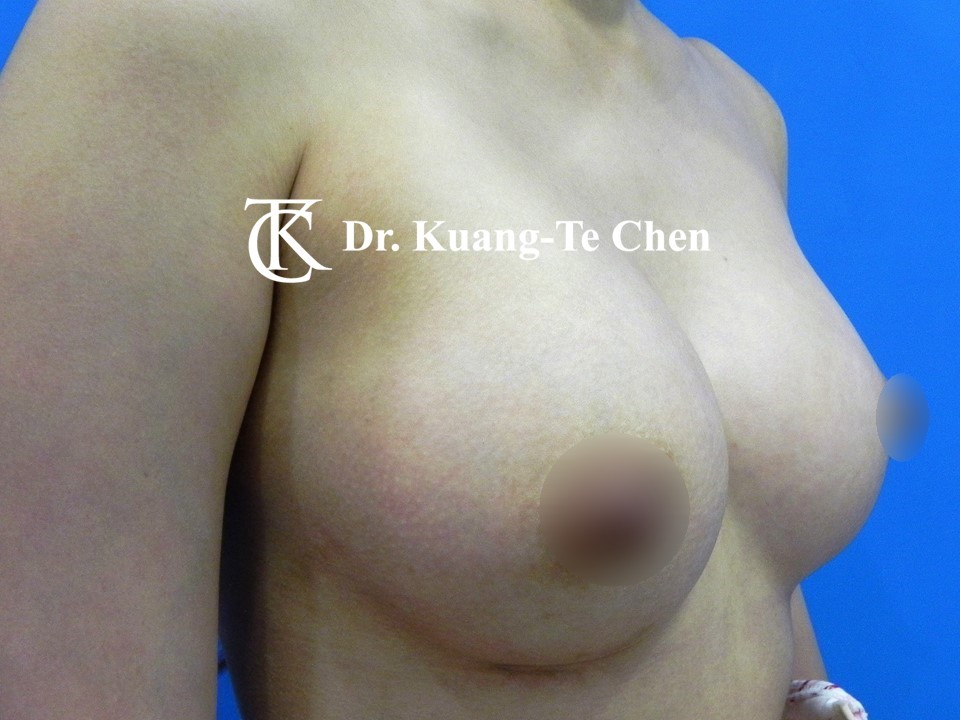 內視鏡隆乳術後