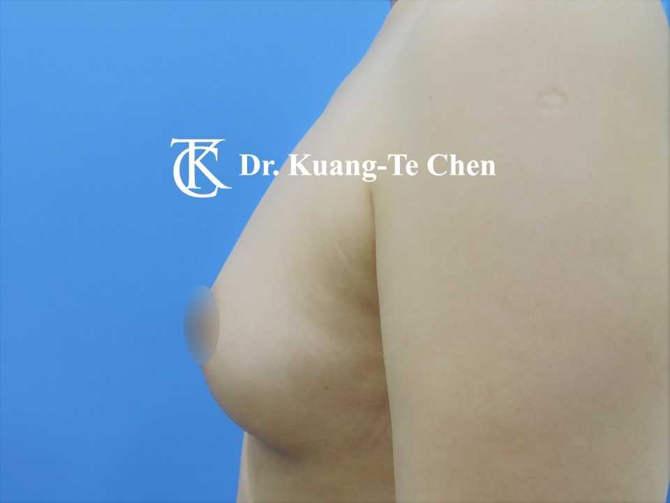 二次自體脂肪移植豐胸二次補脂術後
