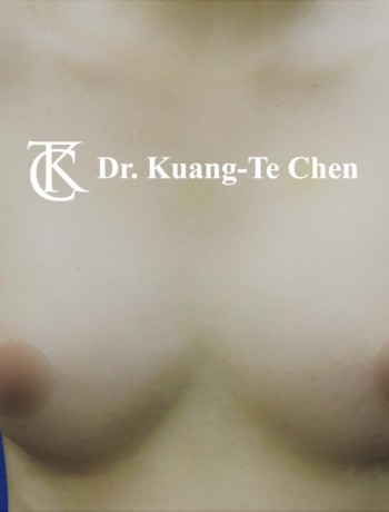 內視鏡隆乳術後