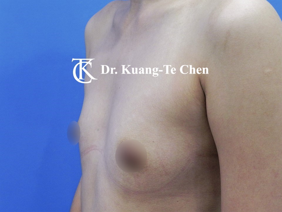 內視鏡隆乳術前
